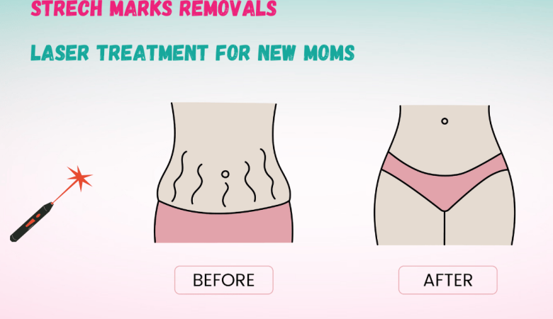 Is Laser Treatment the Right Option for Pregnancy Stretch Marks?